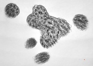 F,7y. | immotile cilia syndrome - nasal mucosa